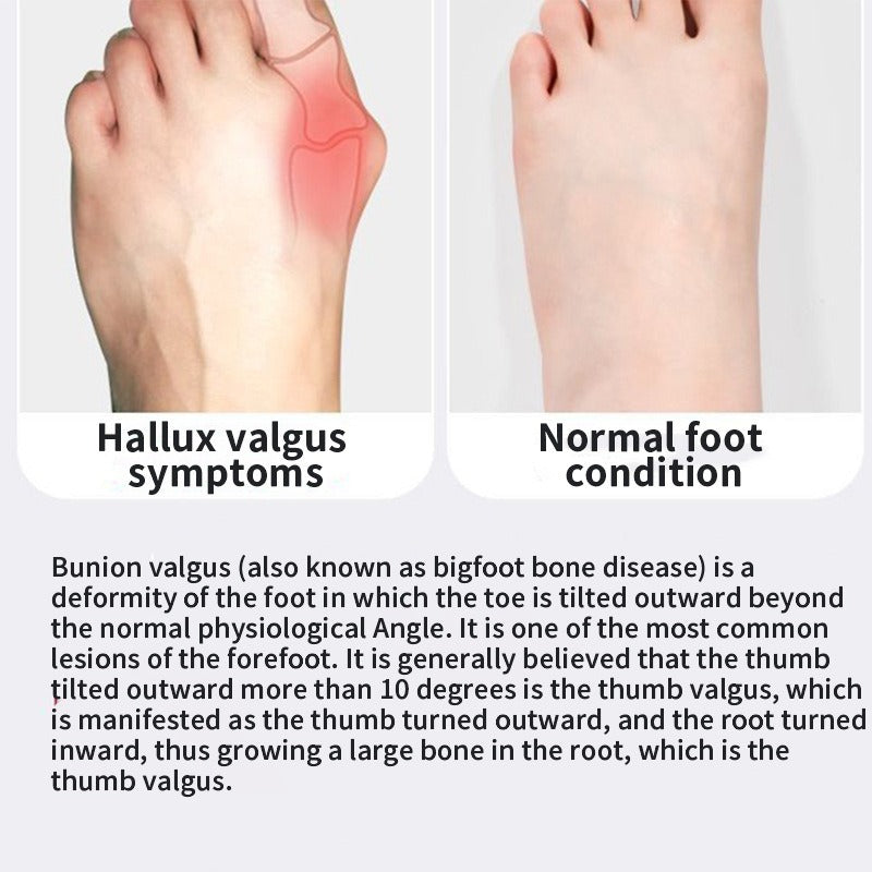 Bunion Relief Toe Separator GidgetBox